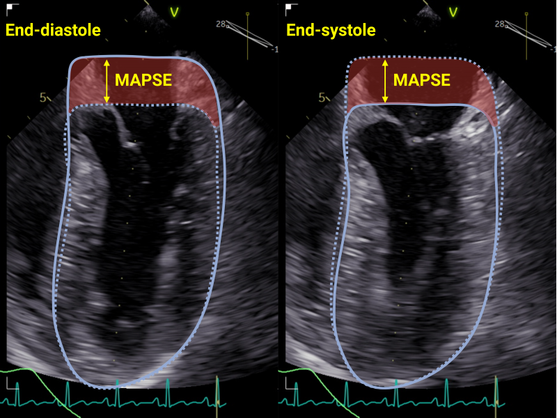 MAPSE: en undervurdert skatt for vurdering av venstre ventrikkelfunksjon?