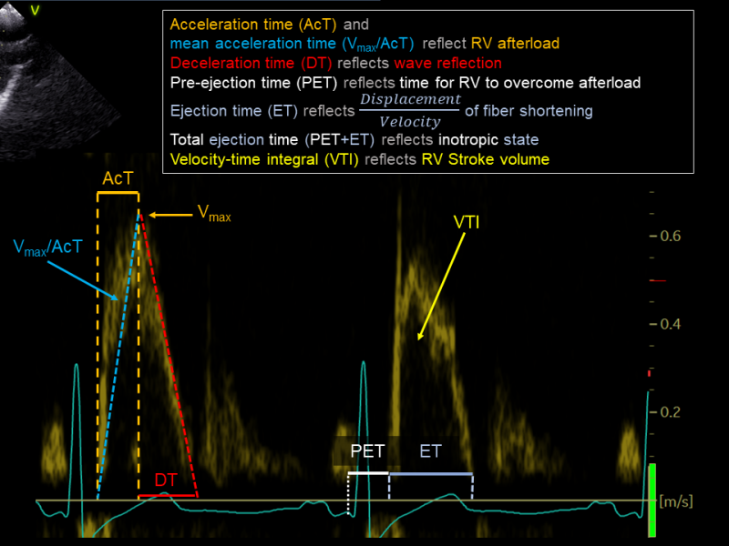 Doppler fra RVOT eller lungearterien (MPA Doppler)